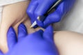In the doctor`s cosmetology office removes unwanted hairs with the help of electrolysis in the armpit area
