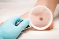 Doctor`s examination of a mole on a person`s leg. The concept of preventing the development of melanoma