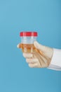 The doctor`s gloved hand holds a transparent container with a urine test