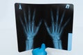 Doctor`s hand in glove holds x-ray of hands Royalty Free Stock Photo