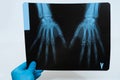 Doctor`s hand in glove holds x-ray of hands Royalty Free Stock Photo