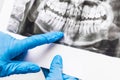 Doctor`s hands in protective medical gloves are holding and examining the x-ray of the teeth, closeup Royalty Free Stock Photo