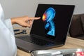 Close up of doctor looking a x-ray of pain in the brain on a laptop. Migraine Headache