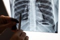 Doctor showing x-ray of patient's lungs. Royalty Free Stock Photo