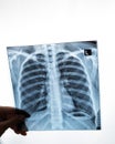 Doctor showing x-ray of patient& x27;s lungs. Royalty Free Stock Photo