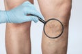 Doctor shows the dilation of small blood vessels of the skin on the leg. Medical inspection and treatment of Telangiectasia,