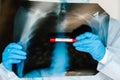 Doctor specialist pulmonary medicine holding radiological, chest x-ray film for medical diagnosis on patient health on infected Royalty Free Stock Photo