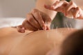 The doctor sticks needles into the girl`s body on the acupuncture - close up Royalty Free Stock Photo