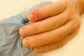 doctor treats injured finger, nail damage from impact, compression, tear, part of male finger injury close-up, bruise, industrial