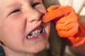 The doctor is trying to see the mouth of a little girl with an orthodontic appliance and crooked teeth Royalty Free Stock Photo