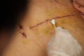 doctor using alcohol and cotton bud cleaning wound from open heart surgery on female body (Heart Valve Regurgitation