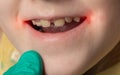 A doctor wearing medical gloves examines the mouth and lip jams of a little girl in the corners of her mouth. Bacterial