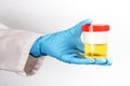 A doctor in a white coat and blue gloves holds a plastic can of urine in hand. urine tests virus, pregnancy, diseases