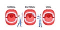 Doctors Characters with Thermometer and Spray for Throat Presenting Normal, Bacterial and Viral Pharyngitis Infection