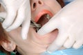 Doctors hands extract a tooth from woman Royalty Free Stock Photo