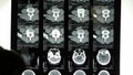 Doctors study skull brain X-ray film for analysis.cerebellum,brainstem.