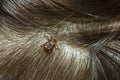 a dog tick attached to hairy scalp of a person Royalty Free Stock Photo