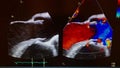 Doppler echocardiogram of aortic valve in action - HD Video