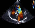 Doppler echocardiography