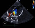 Doppler echocardiography