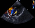 Doppler echocardiography