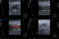 Close up Doppler Ultrasound of Deep Vein Thrombosis Superficial Femoral Vein left thigh Medical healthcare concept