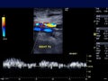 Doppler ultrasound for diagnosis DVT.