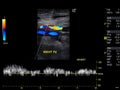 A Doppler ultrasound image in case rule out Deep vien thrombosuis