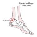 Dorsal spur calcaneal spur. Human foot bones. illustration Isolated on a white background