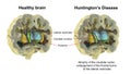 Dorsal striatum and lateral ventricles in healthy brain and in Huntington's disease