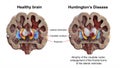 Dorsal striatum and lateral ventricles in healthy brain and in Huntington's disease