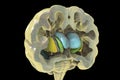 Dorsal striatum and lateral ventricles in Huntington's disease, 3D illustration
