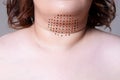 Double chin, injections in the neck, before after anti aging concept Royalty Free Stock Photo