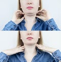 Double chin lift in women. Photos before and after plastic surgery, genioplasty or facebuilding. Royalty Free Stock Photo