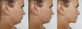 Double chin in women saggy cosmetology mature problem and after treatment
