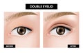 Double eyelid before and after