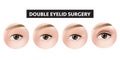 Double eyelid surgery how to step