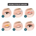 Double eyelid surgery how to step