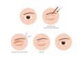 Double eyelid surgery infographic step vector / cosmetic surgery