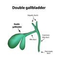 Double gall bladder. Pathology of the gallbladder. Cholecystitis.