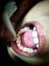 double layer tooth inside a child& x27;s mouth