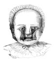 Double rabbit case with division of the cheeks to the eyelids in the old book D`Anatomie Chirurgicale, by B. Anger, 1869, Paris