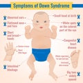 Down Syndrom Symptoms