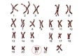 Down-syndrome karyotype Royalty Free Stock Photo