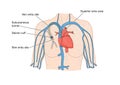 Drawing of catheter insertion into heart