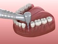 Drilling of bone while dental implant placement. Medically accurate 3D illustration of human teeth and dentures