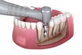 Drilling of bone while dental implant placement. Medically accurate 3D illustration of human teeth and dentures concept