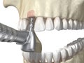 Drilling of the bone for dental implant placement. Medically accurate 3D illustration of human teeth and dentures concept