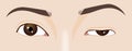 Droopy eyelid ptosis, blepharoplasty symptom, myasthenia gravis, illustration