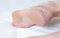 Dry cracked skin on the heels of a person s legs, close-up. The concept of serious diseases of the skin and thyroid gland,